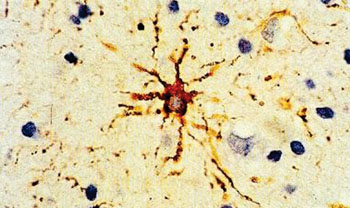 Imagen: Una inmunohistoquímica de la proteína ácida fibrilar de la glía (GFAP) el componente principal de los filamentos que se encuentran en los astrocitos protoplasmáticos y fibrilares en el cerebro. La proteína se visualiza como un depósito de color marrón (Fotografía cortesía de Roy Ellis).