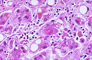 Imagen: Una histopatología de un hígado crónicamente infectado con el virus de la hepatitis C; la necrosis y la inflamación son prominentes, y hay algo de esteatosis también (Fotografía cortesía de la Universidad de Utah).