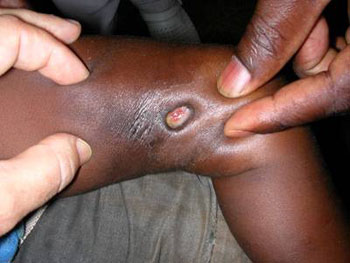 Imagen: Una pequeña úlcera de Buruli causada por Mycobacterium ulcerans (Fotografía cortesía del Dr. A. Chauty, AFRF, Benin).