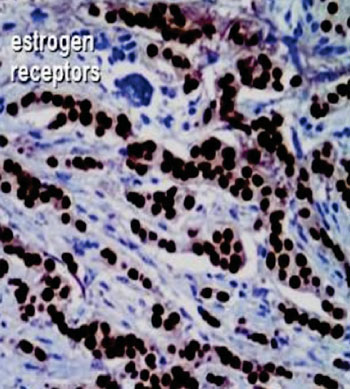Imagen: Una inmunohistoquímica de un cáncer de mama metastásico con receptor de estrógeno (ER) -positivo (marrón) (Fotografía cortesía del Dr. Steven Halls).