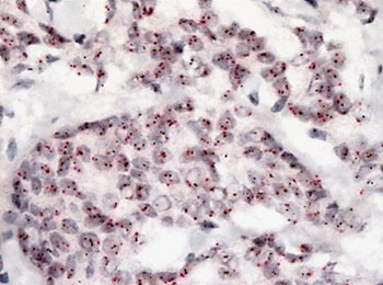 Imagen: Una inmunohistoquímica de mutaciones PIK3CA en una muestra de cáncer de mama (Fotografía cortesía de la Prof. Sibylle Loibl, MD, PhD).