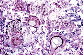 Imagen B: Una microfotografía de bullas pulmonares con tejido necrótico que contienen cabezas conidiales de Aspergillus (Fotografía cortesía del Dr. HM Doran).