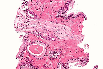 Imagen: Una micrografía de una biopsia de próstata que muestra un adenocarcinoma de próstata, de tipo convencional (acinar), la forma más común de cáncer de próstata (Fotografía cortesía de Nephron).