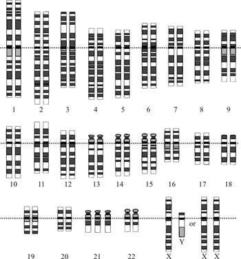 Imagen: El cariotipo para la trisomía 21 o síndrome de Down: la imagen muestra claramente las tres copias del cromosoma 21 (Fotografía cortesía de Wikimedia Commons).