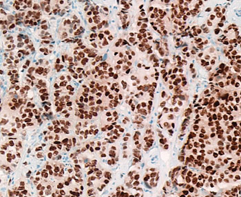 Imagen: Una inmunohistoquímica de una muestra de patología quirúrgica de cáncer de mama positivo para receptores de estrógeno; la mayor parte de los núcleos de las células cancerosas muestran una coloración  fuertemente positiva (marrón oscuro) para los receptores de estrógenos (ER) (Fotografía cortesía del Dr. Ronald S. Weinstein, MD).