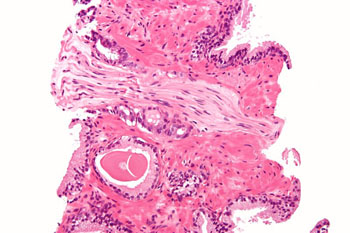 Imagen: Una micrografía de un adenocarcinoma de próstata con invasión perineural, tipo convencional (acinar), la forma más común de cáncer de próstata. Biopsia de próstata, coloración con H&E (Fotografía cortesía de Nephron y Wikimedia).