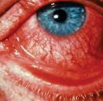 Imagen B: Conjuntivitis viral no purulenta u ojos rojos sin pus, un síntoma de infección por el virus Zika (Fotografía cortesía del Ministerio de Salud de Brasil).