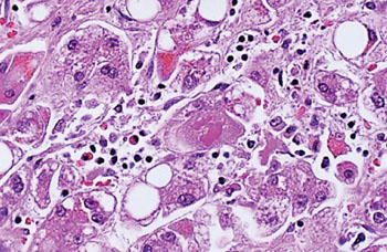 Imagen: Una histopatología de una hepatitis C, viral, crónica; la necrosis y la inflamación son prominentes (Fotografía cortesía de la Universidad de Utah).