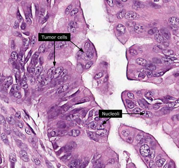 Imagen: Un estudio histopatológico de cáncer epitelial de ovario (Fotografía cortesía del Atlas de Proteínas Humanas).