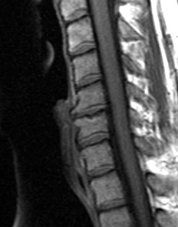 Imagen: Una resonancia magnética sagital T1 ponderada, de columna cervical, que muestra la enfermedad degenerativa del disco, osteofitos y la osteoartritis de C5-C6 (Imagen cortesía de Wikimedia).