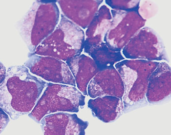 Imagen: Un aspirado de médula ósea de la leucemia mieloide aguda: Se pueden ver los gránulos azurofílicos en prácticamente la totalidad de los blastos y también se puede observar la variabilidad en el tamaño nuclear y el contorno (Fotografía cortesía del Dr. John Lazarchick, MD).