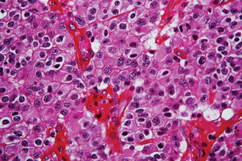 Imagen: Una histopatología de un tumor cerebral, llamado oligodendroglioma, diagnosticado por la lesión altamente celular compuesta por células similares a huevos fritos con limites celulares definidos con atipia nuclear moderada a marcada (Fotografía cortesía de Nephron).