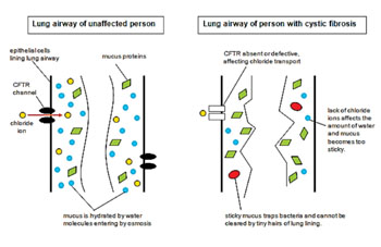 Imagen: Dibujo esquemático que muestra las diferencias entre un pulmón normal y un pulmón con fibrosis quística (Fotografía cortesía del NCHPEG).