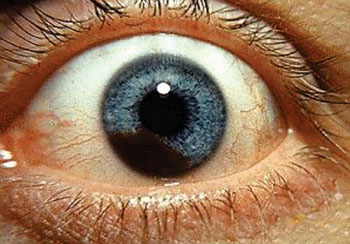Imagen: Un cáncer del iris conocido como melanoma uveal (Fotografía cortesía del Dr. Jonathan Trobe, MD).