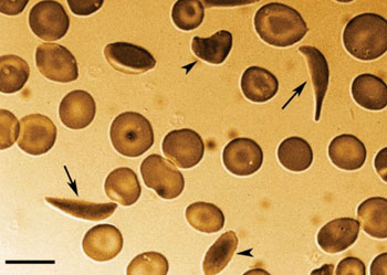 Imagen B: Un frotis de sangre periférica de un paciente con enfermedad de células falciformes (ECF) que muestra varios eritrocitos clásicos en forma de hoz (flechas) y varios otros eritrocitos deformados (puntas de flecha) (Fotografía cortesía de la Facultad de Medicina Monte Sinaí).