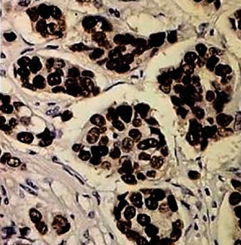 Imagen: Una inmunoquímica para los receptores de estrógenos (ER), una coloración nuclear fuerte y difusa en una muestra de tejido de una paciente con cáncer de mama (Fotografía cortesía de Steven Salas, MD).