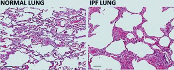 Imagen: Una histopatología de la arquitectura del pulmón en la fibrosis pulmonar idiopática (FPI), que se caracteriza por un patrón llamado “panal de abeja” y con las vías respiratorias separadas por bandas de tejido conectivo fibroso inflamado y en menor medida, de músculo liso (Fotografía cortesía del Dr. Robert Dunstan).