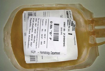 Imagen B: Una bolsa de transfusión de crioprecipitado, que contiene aproximadamente 350 mg de fibrinógeno (Fotografía cortesía de Perfusión).