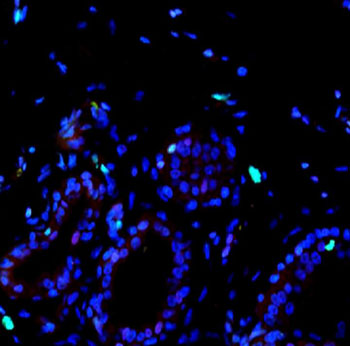 Imagen: En el tejido sano de mama, el porcentaje de células que expresan el marcador molecular, Ki67 (verde) y p27 (rojo), fue baja (Fotografía cortesía de Sung Jin Huh, Facultad de Medicina de Harvard).