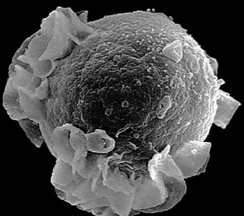 Imagen: Una micrografía electrónica de barrido (SEM) del virus de Epstein-Barr en gemación y un linfocito B (Fotografía cortesía de la Facultad de Medicina Albert Einstein).