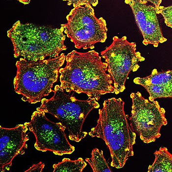 Imagen: La capacidad de las células cancerosas para moverse y propagarse depende de las estructuras básicas ricas en actina tales como los podosomas (amarillo) que se muestran aquí en las células de melanoma. También se muestran los núcleos celulares (azul), la actina (rojo), y un regulador de actina (verde) (Fotografía cortesía de Julio C. Valencia y Daniel Mietchken, vía Wikimedia).