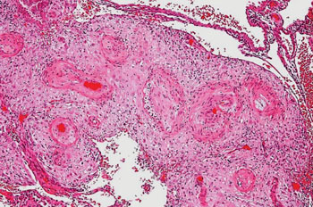 Imagen: Una microfotografía que muestra la vasculopatía decidual hipertrófica, un hallazgo observado en la hipertensión gestacional y la preeclampsia (Fotografía cortesía de la revista Nephron).