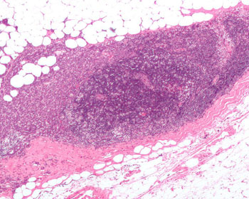 Imagen: una micrografía que muestra un nódulo linfático invadido por carcinoma de mama ductal, con la extensión del tumor más allá de los ganglios linfáticos. Tinción con H&E. El color púrpura oscuro (centro) son linfocitos (parte de un ganglio linfático normal). Alrededor de los linfocitos extendiéndose a la grasa circundante (parte superior de la imagen) se encuentra el carcinoma ductal de mama (Fotografía cortesía de Michael Bonert/Wikimedia).