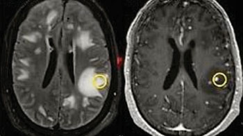 Imagen: Una resonancia magnética de una lesión cerebral (blanco) en un paciente con tuberculosis del estudio. El círculo amarillo indica la ubicación de la biopsia (Fotografía cortesía de la Universidad Johns Hopkins).