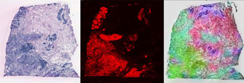 Imagen: Una micrografía de un adenocarcinoma de próstata, de tipo acinar, el tipo más común de cáncer de próstata. Biopsia por aspiración, coloración con H&E (Fotografía cortesía de Nephron).