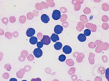 Imagen: Un frotis de sangre de un paciente pediátrico con leucemia linfoide aguda de células B precursoras (Fotografía cortesía del Dr. Peter Maslak, MD).