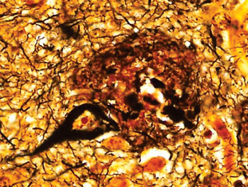 Imagen: Un corte de histopatología del tejido cerebral de un paciente con Alzheimer que muestra ovillos neurofibrilares y placas neuríticas (Fotografía cortesía del Dr. Dimitri P. Agamanolis, MD).
