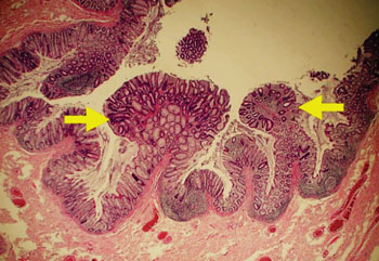 Imagen: Una histopatología del colon con múltiples pólipos adenomatosos (Fotografía cortesía de Grupo 14).