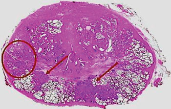 Imagen: Un corte de todo el montaje de la próstata a partir de una muestra de cistoprostatectomía con extensión del carcinoma urotelial de la vejiga a la próstata (flechas). El área cercada es un carcinoma de próstata incidental (Fotografía cortesía de la revista European Urology).