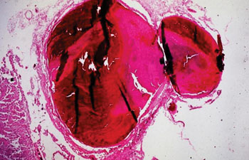 Imagen: Una histopatología del tejido cerebral mostrando un tromboembolismo venoso agudo de etiología desconocida (Fotografía cortesía de Peter Anderson).