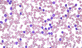 Imagen: Un frotis de sangre que muestra la leucemia linfoide crónica (Fotografía cortesía de Peter Maslak/ASH).