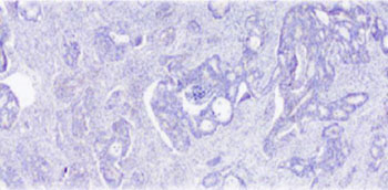 Imagen: Una vista microscópica de un corte de cáncer de colon (Fotografía cortesía del IDIBELL-Instituto de Investigación Biomédica de Bellvitge).