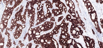 Imagen: Un caso positivo de tejido pulmonar detectado por coloración de IHQ para la quinasa del linfoma anaplásico (ALK) con el análisis Ventana ALK (D5F3) CDx (Fotografía cortesía de Ventana).