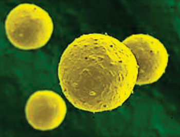 Imagen: Una micrografía electrónica de barrido a color (SEM) de las células de cáncer de esófago (Fotografía cortesía de la Universidad de California-Davis).