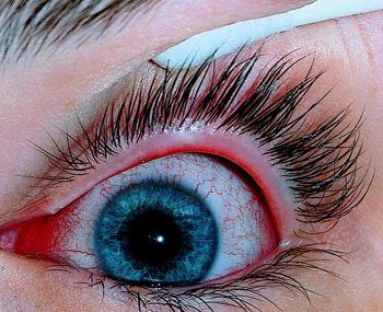 Imagen: Un ojo con conjuntivitis viral (Fotografía cortesía de Wikimedia).