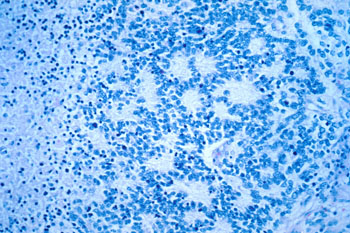 Imagen: Una vista microscópica de un neuroblastoma típico con formación de rosetas (Fotografía cortesía de la Dra. María Tsokos, Instituto Nacional del Cáncer).