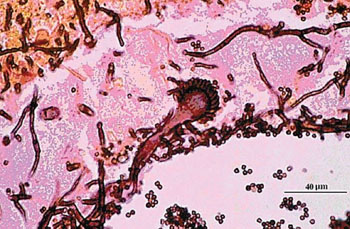 Imagen: Una histología de Aspergillus fumigatus en tejido pulmonar (Fotografía cortesía del CDC).