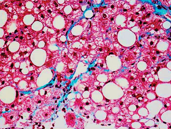 Imagen: Un estudio histopatológico de la esteatohepatitis no alcohólica (NASH) en una biopsia de hígado (Fotografía cortesía de SPL).