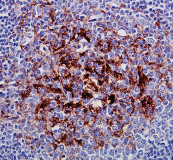 Imagen: Una microfotografía de la inmunocoloración de una proteína priónica en una biopsia en un paciente con la enfermedad variante de Creutzfeldt-Jakob (Fotografía cortesía de SPL).