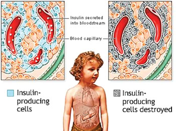 Imagen: Un diagrama de la diabetes tipo 1 como una enfermedad autoinmune (Fotografía cortesía de los Institutos Nacionales de Salud de los Estados Unidos).