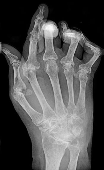 Imagen: Un examen de rayos-x, típico, de una mano con artritis reumatoide (Fotografía cortesía de Wikimedia).