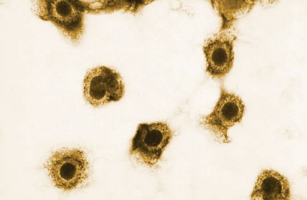 Imagen: El microscopio electrónico de transmisión (TEM) muestra los números de viriones de citomegalovirus (CMV) que estaban presentes en una muestra de tejido (Fotografía cortesía de Sylvia Whitfield).
