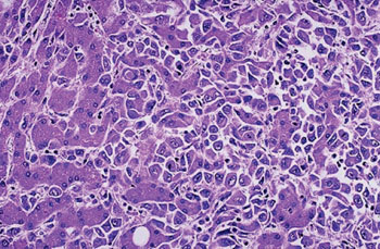 Imagen: Una imagen de histopatología del carcinoma hepatocelular: las células malignas que se ven, sobre todo, a la derecha están bien diferenciadas e interdigitadas con hepatocitos normales más grandes, vistos principalmente a la izquierda (Fotografía cortesía de SPL).