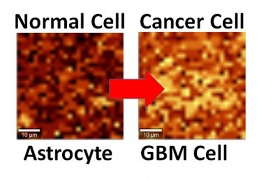 Imagen: Células cerebrales normales y cancerosas haciendo interfaz con el grafeno y mostrando diferentes niveles de actividad utilizando la espectroscopía Raman (Fotografía cortesía de Vikas Berry, Universidad de Illinois en Chicago).