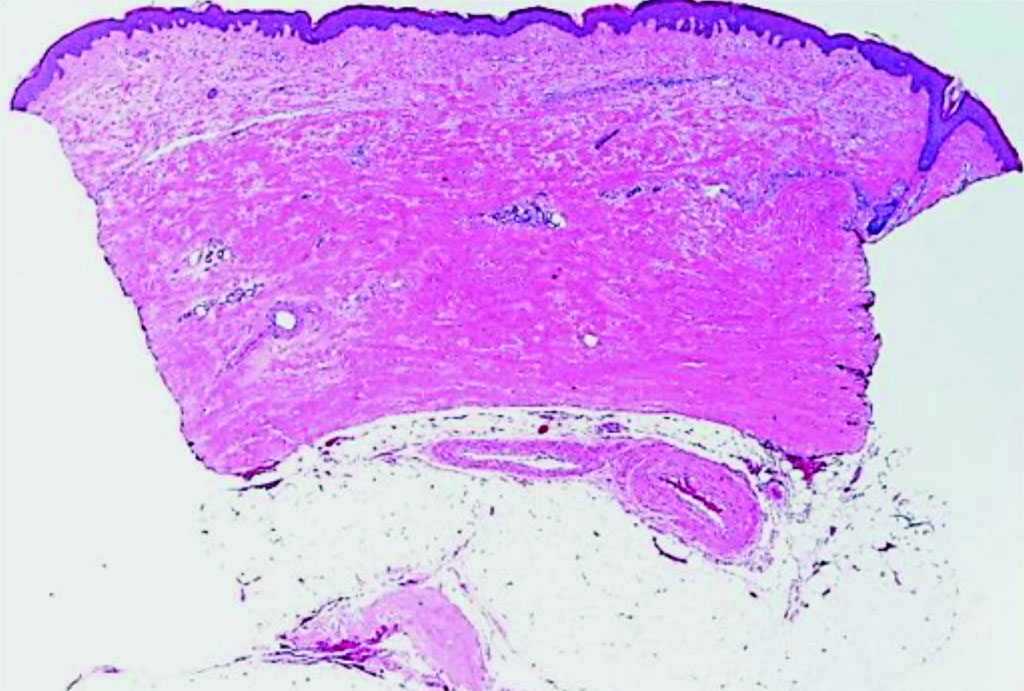Imagen: Una histopatología de un espécimen de una biopsia de perforada en un paciente con esclerosis sistémica (Fotografía cortesía del Dr. Soumya Chatterjee, MD, MS, FRCP).