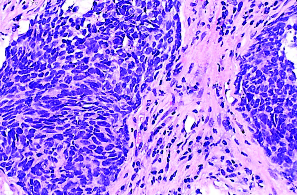 Imagen: Una histopatología de un carcinoma pulmonar de células no pequeñas (Fotografía cortesía de Librepath).